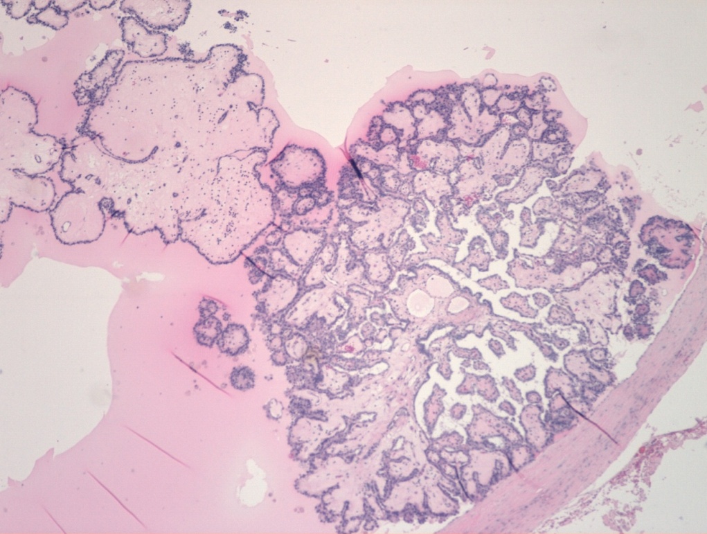 Synchronous Papillary Carcinoma of Thyroglossal Duct Cyst and Papillary Thyroid Carcinoma