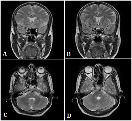 Lateral Rectus Palsy Associated with Isolated Sphenoid Sinus Fungal Lesion