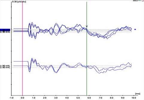 Long Ringing Cochlear Microphonics - Not Unique to Auditory Neuropathy Spectrum Disorder in Children