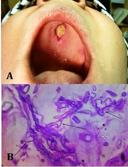 Successful Treatment of Maxillary Mucormycosis: Report of a Case and Literature Review