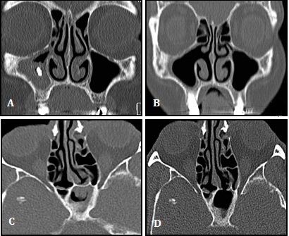 Maxillary and Sphenoid Sinus Fungus Ball: A Single Belgian Centre's Experience