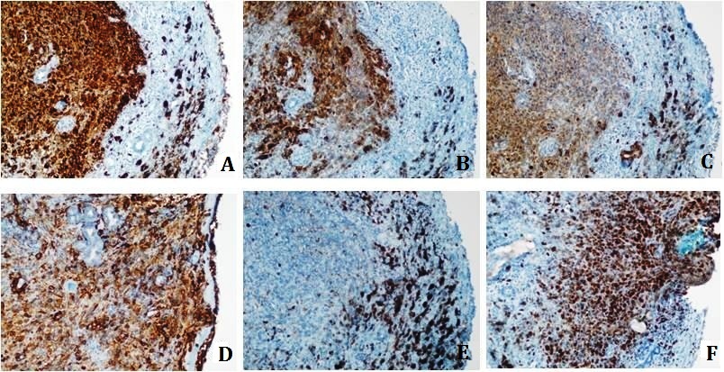 Mucosal Malignant Melanoma of Inferior Concha and Nasal Septum: A Case Report with Mutation Analysis