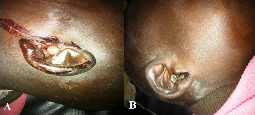 Skull Base Penetration Due to
Unusual Bilateral External Auditory Canal Injury in a Child Accused of Witchcraft: A Case Report and Review of the Literature