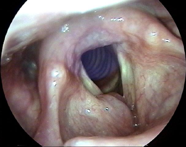 Internal Laryngocele and Zenker's Diverticulum Masquerading as a Laryngeal Fracture and Esophageal Perforation and Rupture