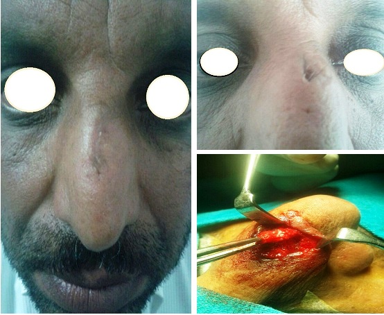 Pilonidal Sinus of Nasal Dorsum: A Common Disease at Uncommon Site