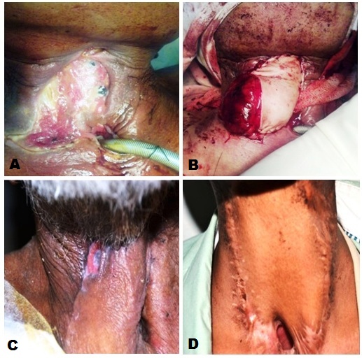 Changing Paradigm for Ryle's Tube Removal after Total Laryngectomy