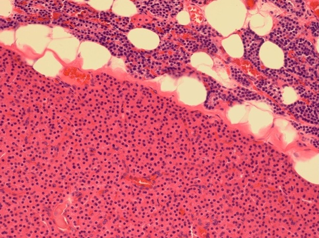 Sestamibi Localization of a Parathyroid Adenoma in the Presence of a Thymoma: a Case Report and Review of the Literature