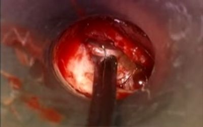Robot-Assisted Mediastinal Parathyroidectomy: Collaboration Between Otolaryngology and Thoracic Surgery