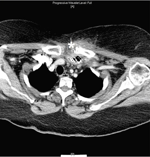 Neck Abscess and Osteomyelitis Secondary to a Sternoclavicular Septic Arthritis: a Case Report