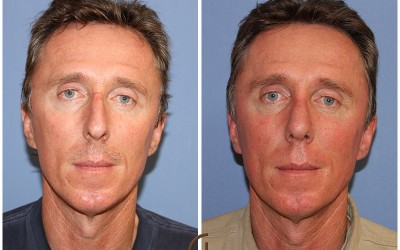 Identical Twins Rhinoplasty: Challenges & Psychological Aspects