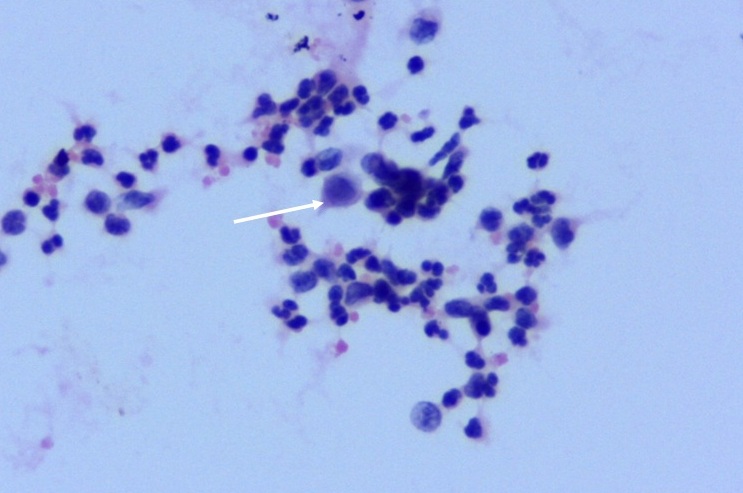 Role of Fine Needle Aspiration Cytology (FNAC) as a Diagnostic Tool in Paediatric Head and Neck Lymphodenopathy