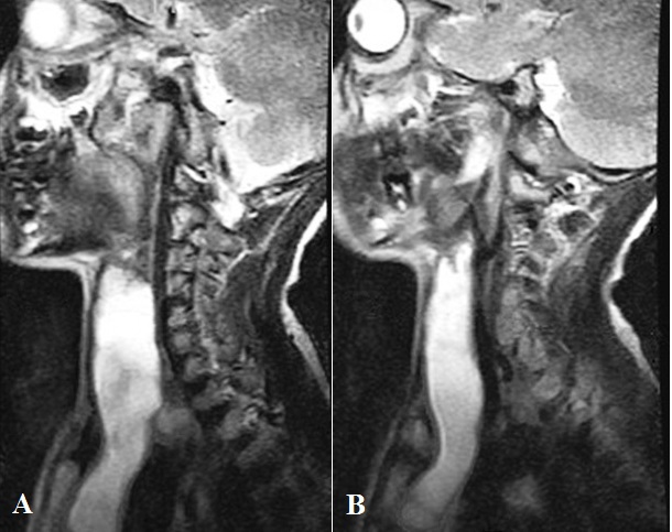 Multilocular Cervical Thymic
Cyst: Rare Cervical Lesion should
kept in Mind in Differential
Diagnosis of Pediatric Cervical
Masses