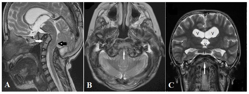 Sensorineural Hearing Loss in
Hajdu-Cheney Syndrome