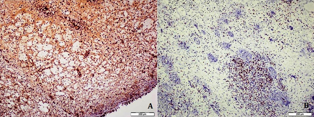 Immunohistopathologic Distinctive
Features of Primary and Recurrent
Nasal Polyps