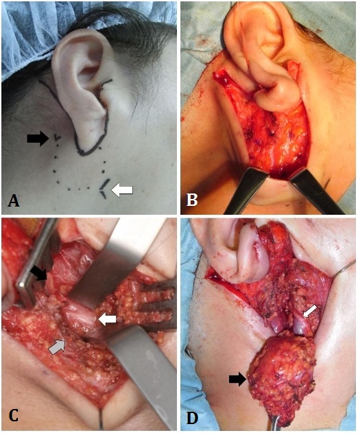 Parotidectomy by U-shaped Skin
Incision for small Benign Tumors