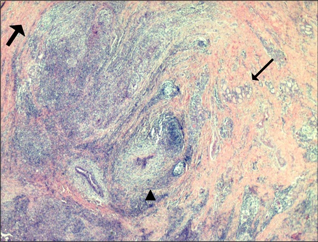 4th Branchial Cleft Cyst Anomaly:
Case Presentation