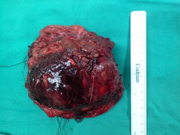 A Rare Presentation of
Carcinosarcoma in a Long
Standing Parotid Mass