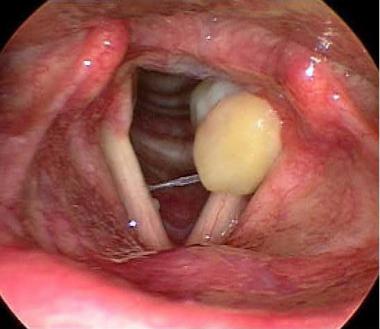 Treatment of Recurrent Vocal Cord Granuloma with Percutaneous Steroid Injection