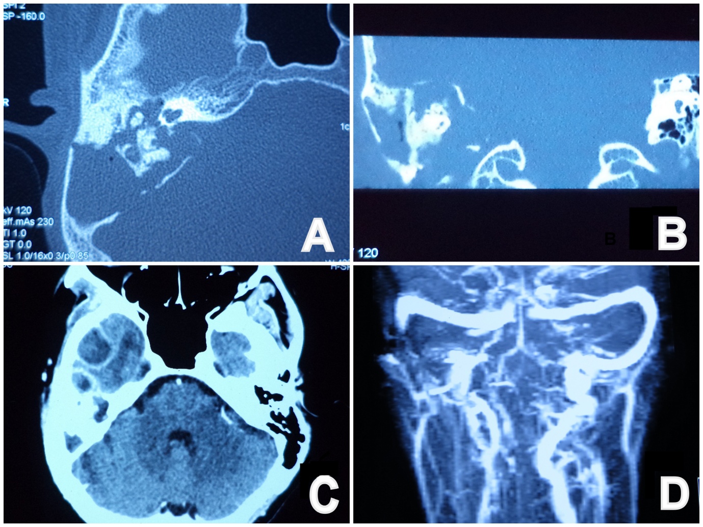 Congenital Cholesteatoma of
Inner Ear: Still a dilemma