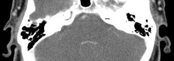 Langerhans Cell Histiocystosis
of Temporal Bone: Case Reports