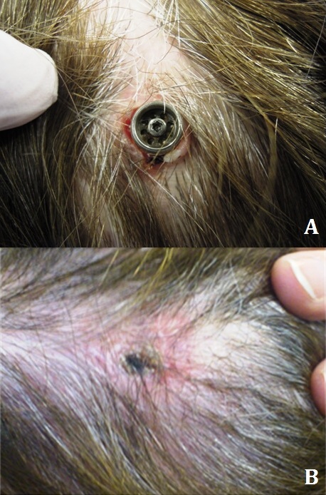Using the Existing Fixture
in a Bone Osseointegrated
Implant for Switching to a
Transcutaneous system: Case
Reports with Three Possible
Scenarios
