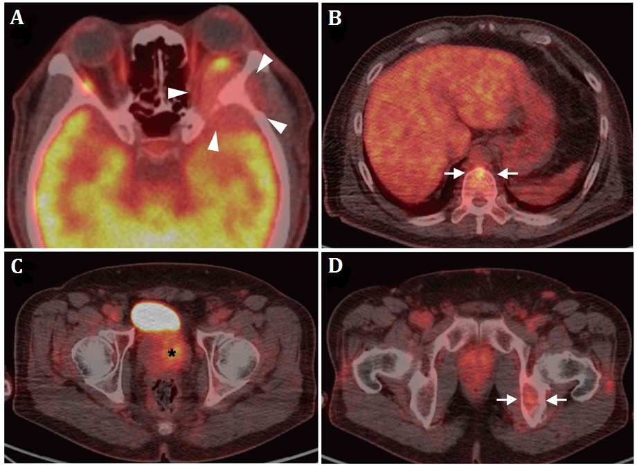 Sphenoid wing Metastasis from
Occult Prostatic Carcinoma