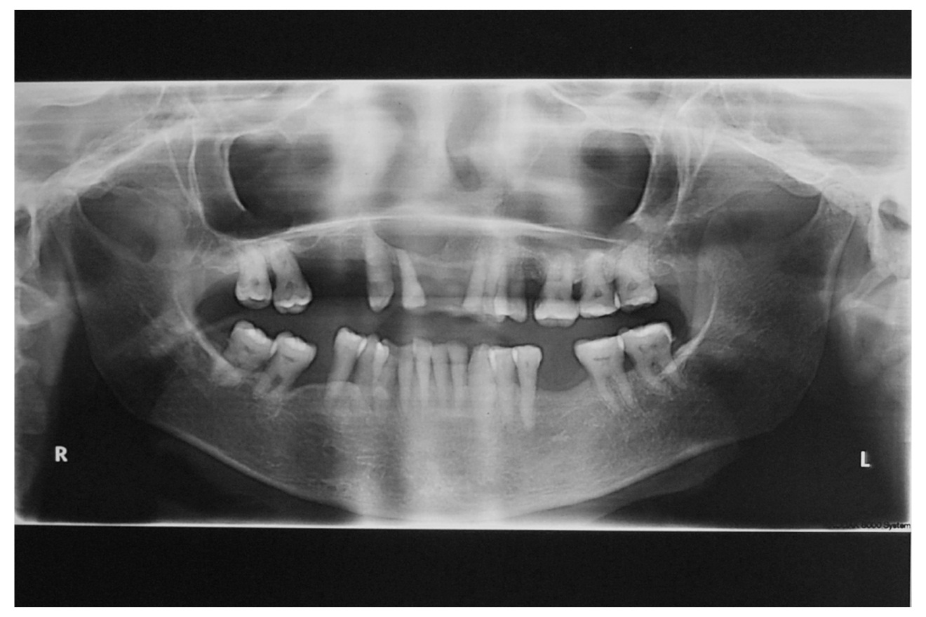 Intraosseous Schwannoma
(Neurilemmoma): An Unusual
Anterior Maxillary Swelling:
A Case Report and Review of
Literature