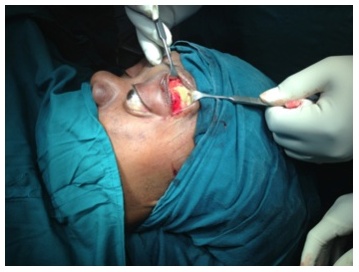 Superolateral Orbital Abscess
Complicating Frontal Sinusitis -
Need to Emphasize the External
Approach