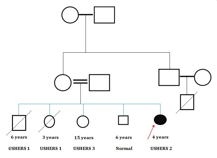 Case Series of all three types
of Ushers Syndrome of varying
severity in the same family