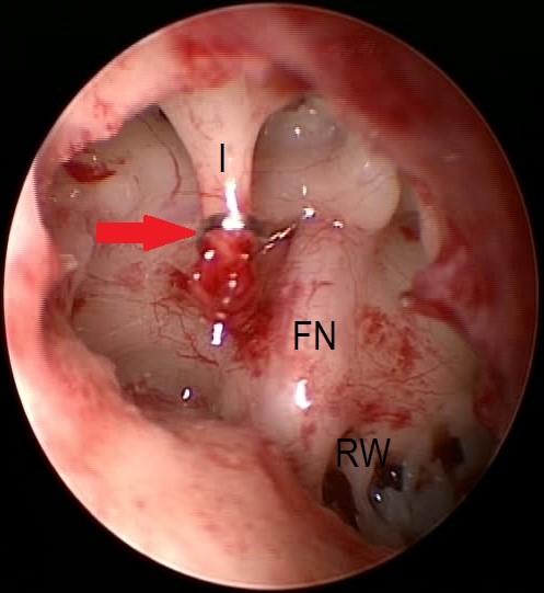 Endoscopic Stapedotomy for Congenital Absence of Stapes