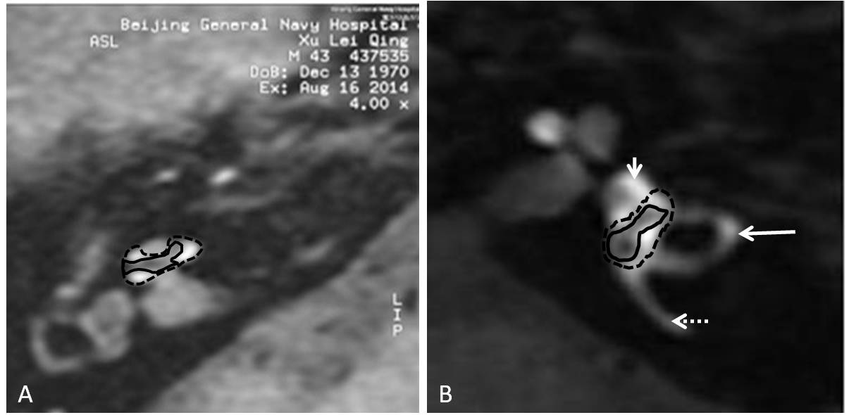 The Reliability of 3T MRI in Detecting Endolymphatic Hydrops in the Meniere’s Disease and Sudden Sensorineural Hearing Loss