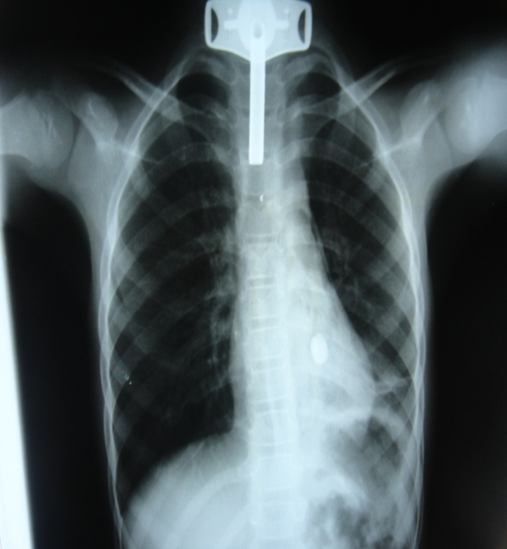 Thoracotomy for Bronchial Foreign Bodies: A Propos of 3 Cases