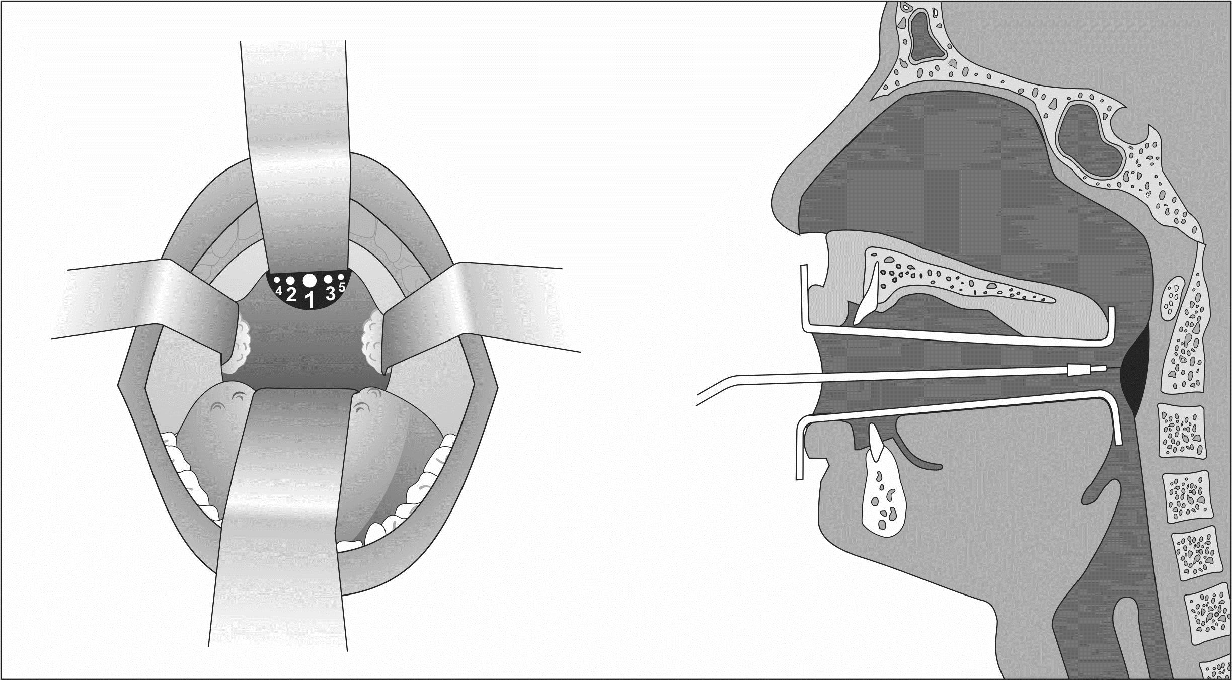 Autologous Fat Graft for the Correction of Minor Velopharyngeal Insufficiency