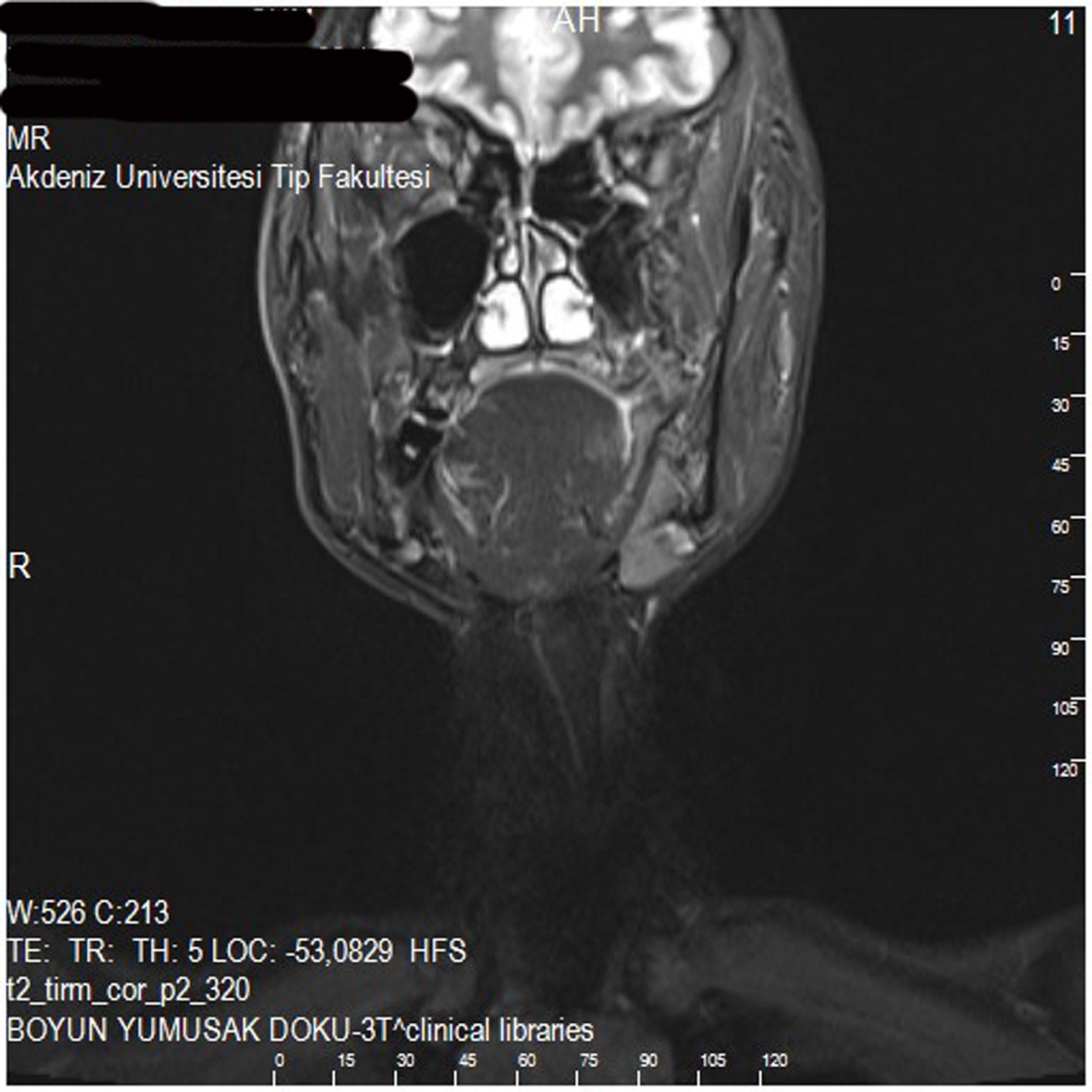 Alveolar Soft Part Sarcoma Presenting with Nasal Obstruction