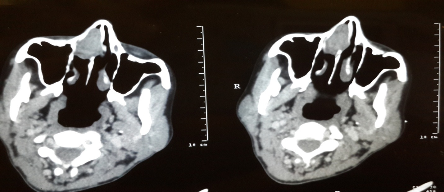 Schwannoma of Nasal Septum: An Unusual Cause of Epistaxis and Nasal Obstruction