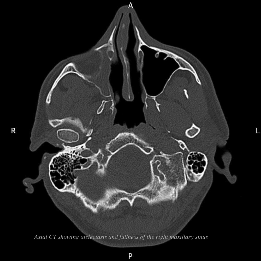 Facial Asymmetry as a Presentation of Silent Sinus Syndrome