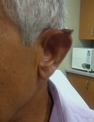 Keratoacanthoma in the Ear Helix in Patient with Chronic Renal Failure