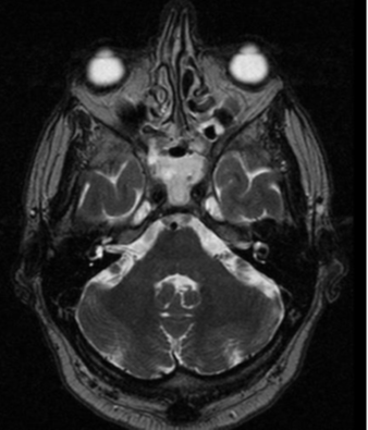 Invasive Fugal Sinusitis Causing Massive Epistaxis: A Case Report