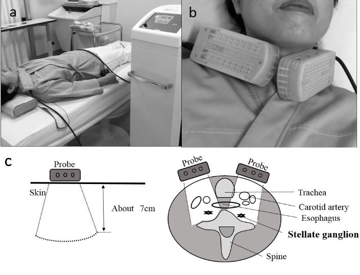 Treatment of Chronic Tinnitus by Xenon Phototherapy on the Stellate Ganglion