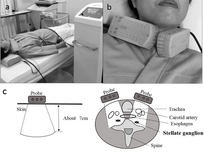 Treatment of Chronic Tinnitus by Xenon Phototherapy on the Stellate Ganglion