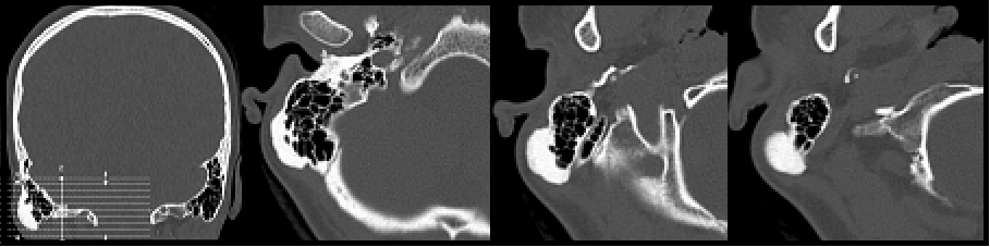 A Case of Mastoid Osteoma