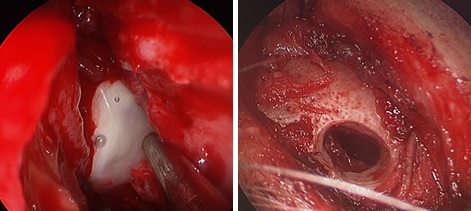 Management of Intracranial Complications of Acute Sinusitis: Our Experience Regarding a Series of Clinical Cases