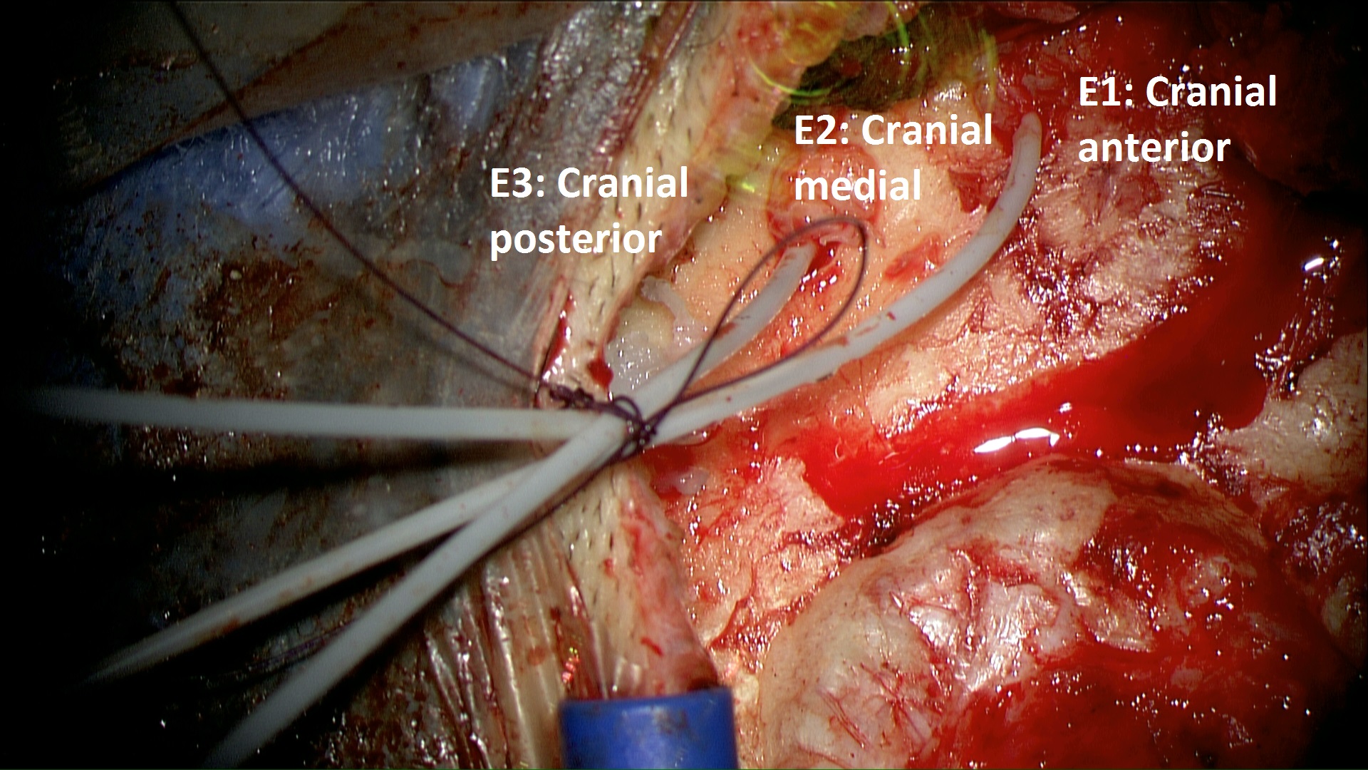 Epidural Recordings of Auditory Evoked Potentials in Cochlear Implant Users: First Experiences