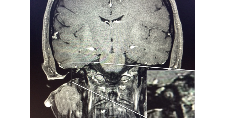 Spontaneous Cochlear Hemorrhage in an otherwise Healthy Patient: A Case Report