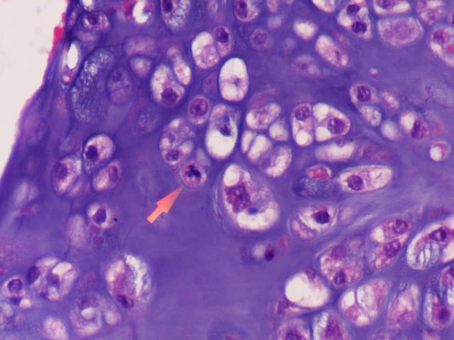 Clinical Diagnosis and Management of Septal Chondrosarcoma