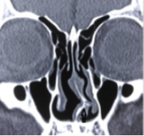 Prevalence of Anatomical Variants on Computed Tomography of Nose and Paranasal Sinuses