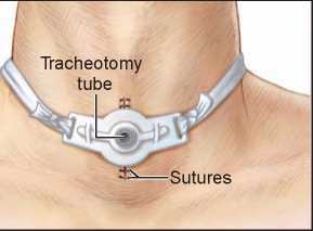 Morbidities and Risk Factors Associated with the Complications of Tracheotomy