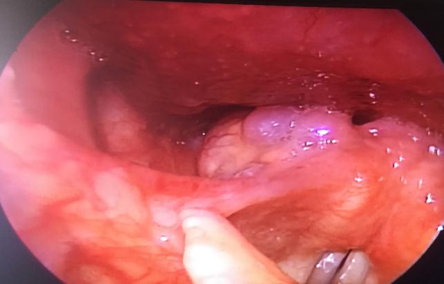 Benign Fibrous Histiocytoma of Larynx, an Uncommon Finding