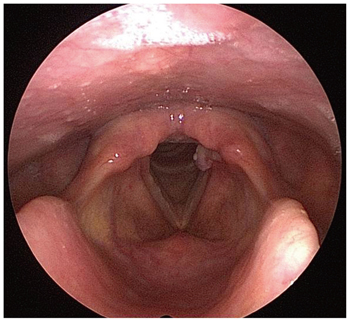 The Case of Laryngeal Lipoma