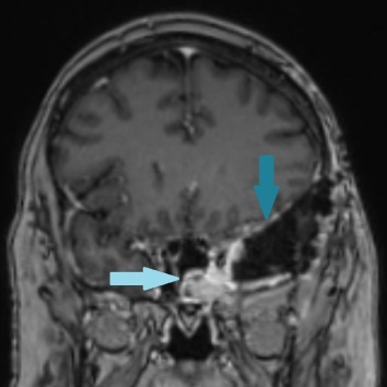 Sphenoid Sinus Meningioma: A Case Report with Review of Literature